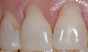 Remedies For Receding Gums