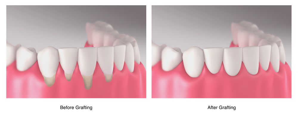 How To Fix Receded Gums