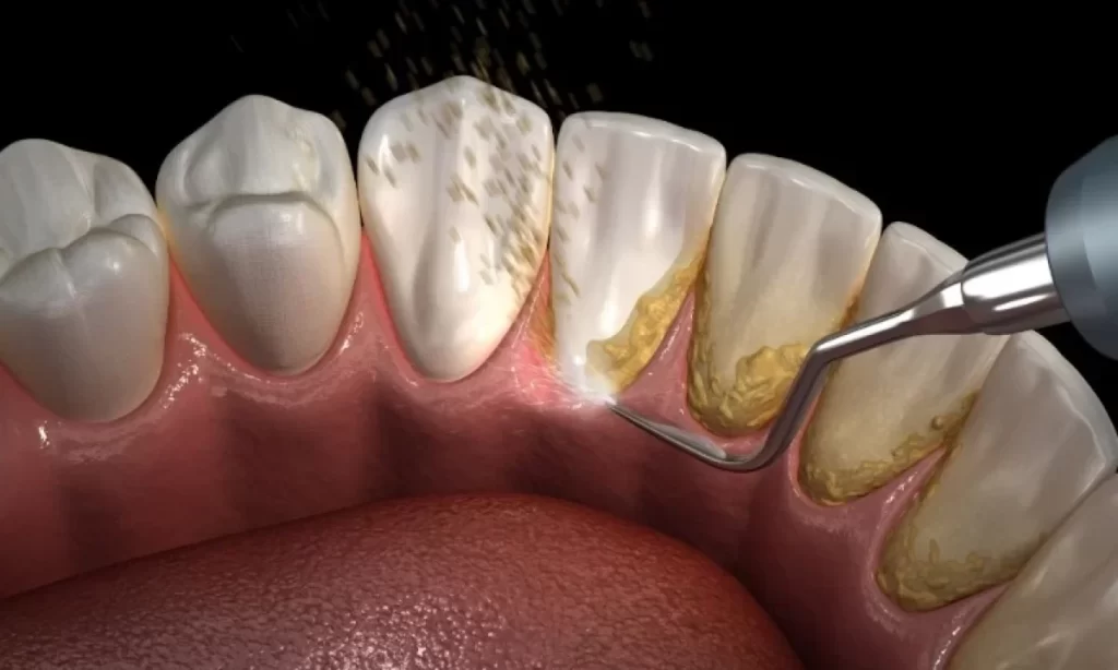 Repairing Gum Recession