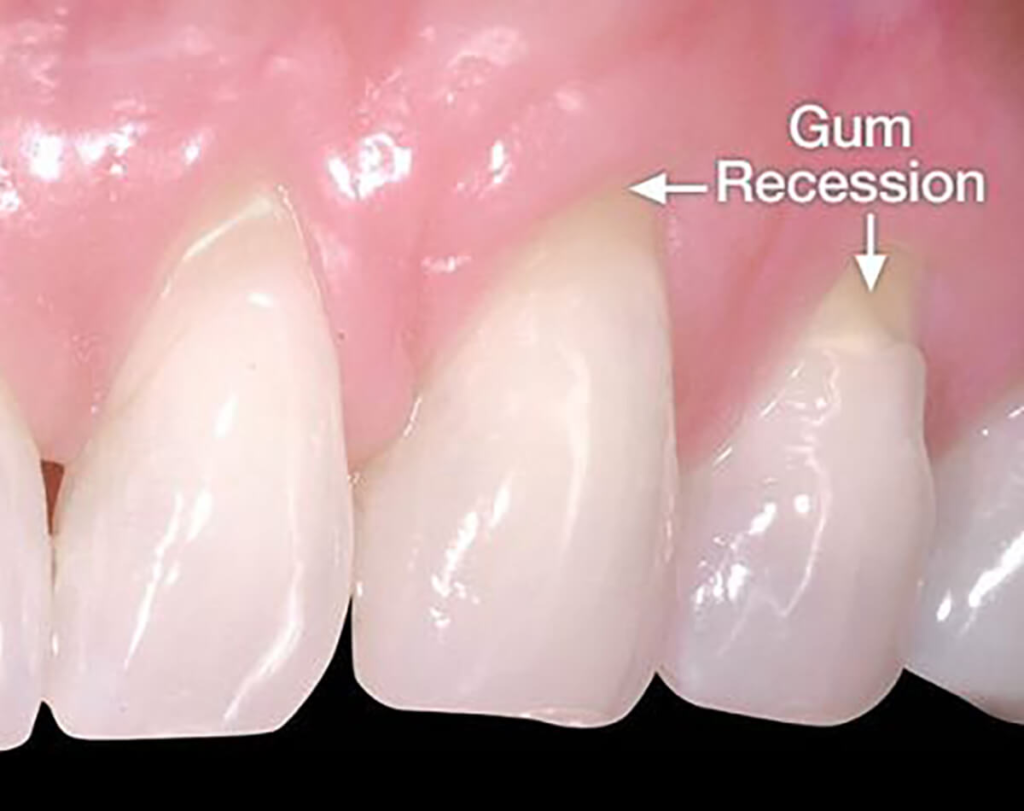 Grow Gums Back Naturally