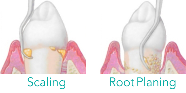 Scaling And Root Planing